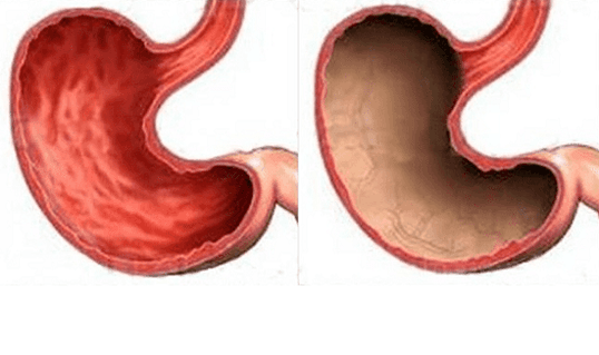 Ulcer, gastritis, cancer and other pathologies of the stomach (on the right), the appearance of which was caused by alcohol. 